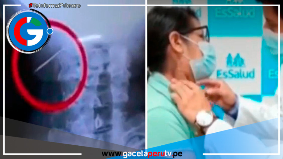 La Victoria: Mujer se traga un clavo mientras comía pan con chicharrón